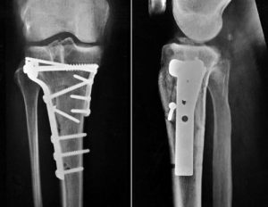 Tibiaplateau Fractuur Heelkunde Protocollen